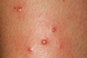 Pustules