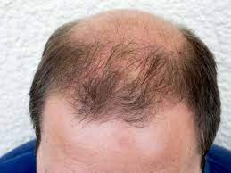 Androgenic alopecia