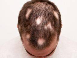 alopecia-areata