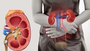Kidney failure symptoms